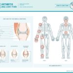 Arthritic joint pain and common areas it occurs