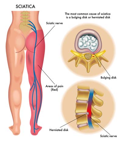 sciatica nerve pain and chiropractic