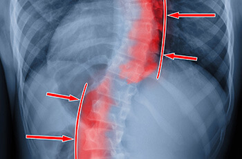 scoliosis and chiropractic care