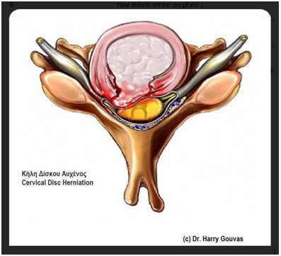 Image of Disc Herniation