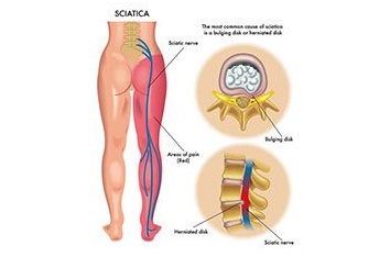 Image of Lower Back Pain